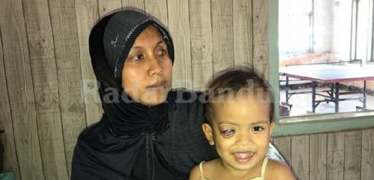 Balita Penderita Tumor Mata Butuh Bantuan