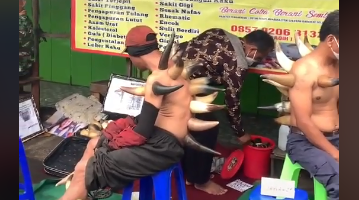 Viral Terapi Bekam Tanduk Api, Pasien Jadi Mirip Godzilla