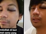 Kondisi Rian D'Masiv yang luka di bagian mata usai mengalami kecelakaan.