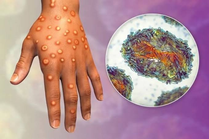 RSHS Bandung Lakukan Deteksi Dini Jika Ada Gejala Mpox
